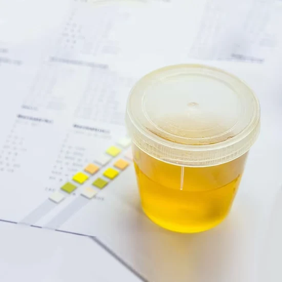 urine spot calcium test